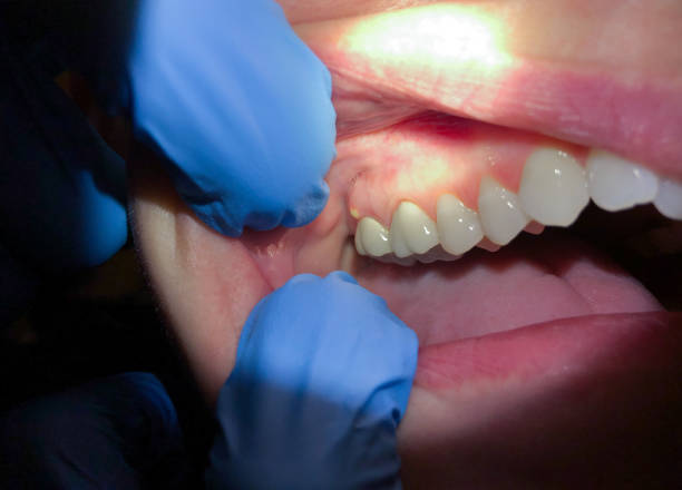 Best Emergency Treatment for Dental Infections or Abscesses in Nappanee, IN